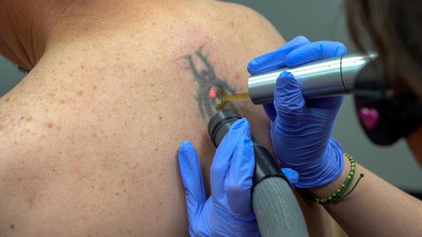 The process is handled with the use of a laser by a trained professional.