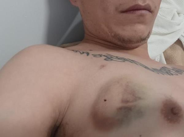 Martinez has a giant bruise on his chest.