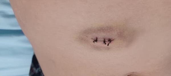 Stiches from wher<em></em>e Martinez was stabbed.