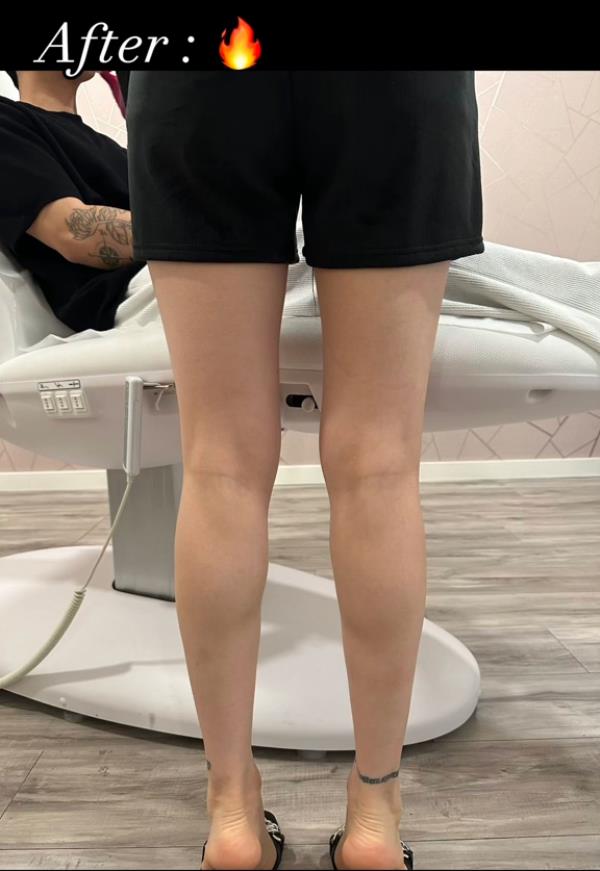 You?ve heard of Botox for wrinkles, but have you heard of ?calf tox? to slim your calves? It?s all the rage on TikTok</p>

<p>　　